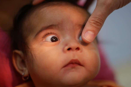 اختلالات بینایی کودکان