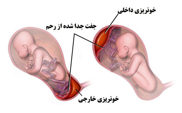 عوارض جفت زمان بارداری
